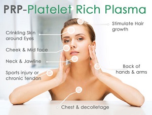 Diagram of areas that can be treated with PRP