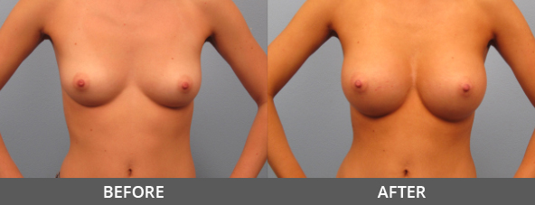 Before and After Breast Augmentation Naples, FL