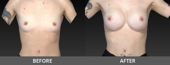 Before and After Breast Augmentation Naples, FL
