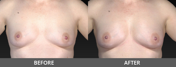 Before and After Breast Augmentation Naples, FL