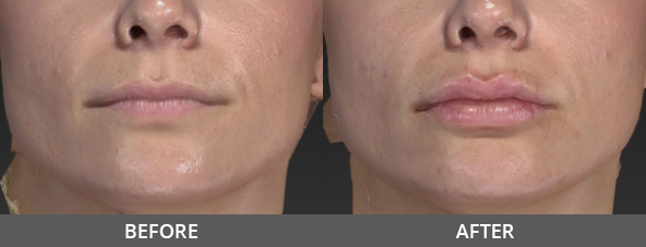 Lip Augmentation Before and After