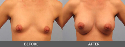 Breast Augmentation Gallery