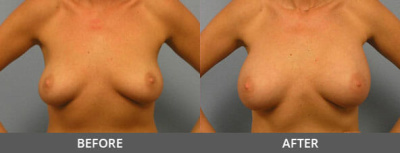 Breast Augmentation Gallery