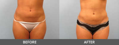 Body Contouring Gallery