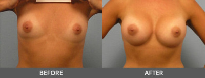 Breast Augmentation Gallery