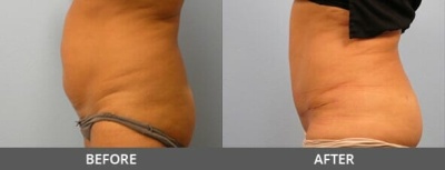 Tummy Tuck Gallery