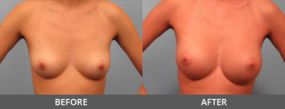 Breast Augmentation Gallery