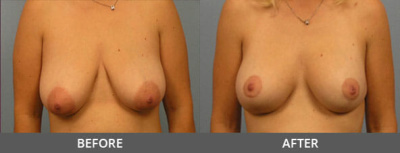 Breast Lift Gallery