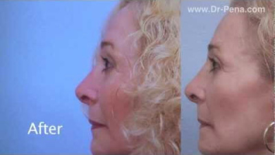 Facelift Fat Graft - Post-Op 