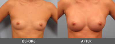 Breast Augmentation Gallery