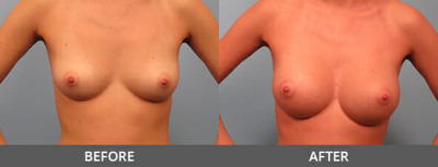 Breast Augmentation Gallery