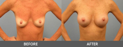 Breast Augmentation Gallery