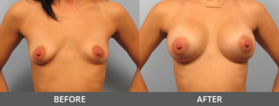 Breast Augmentation Gallery