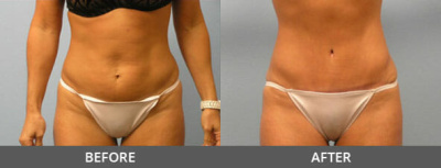 Tummy Tuck Gallery