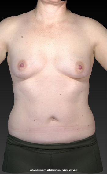 Before and After Body Contouring