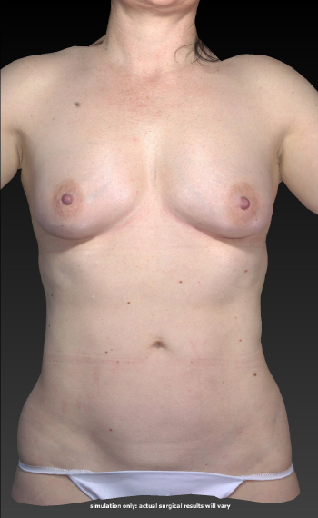 Before and After Body Contouring