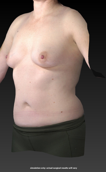 Before and After Body Contouring
