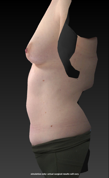Before and After Body Contouring