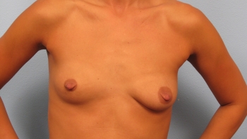 Before and After Breast Augmentation