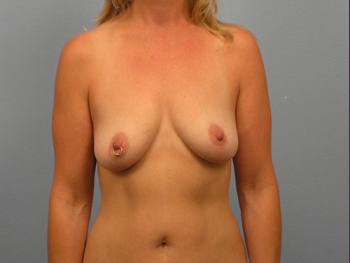 Before and After Breast Augmentation