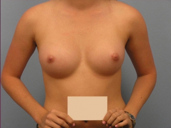 Before and After Breast Augmentation