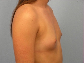 Before and After Breast Augmentation
