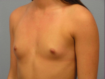 Before and After Breast Augmentation