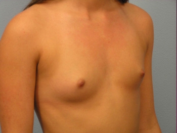 Before and After Breast Augmentation