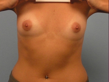 Before and After Breast Augmentation