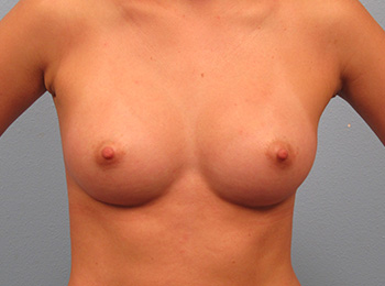 Breast Augmentation After