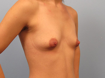 Breast Augmentation Before