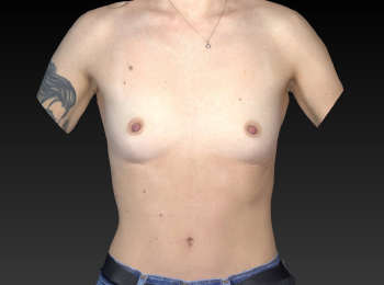Before and After Breast Augmentation