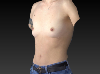 Before and After Breast Augmentation