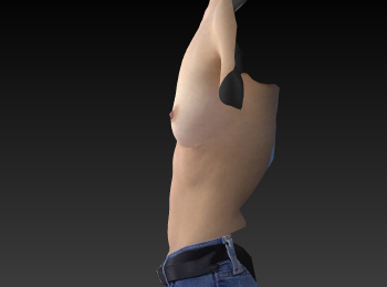 Before and After Breast Augmentation