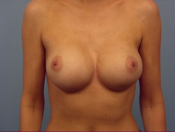 Before and After Breast Lift