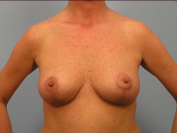 Before and After Breast Reduction