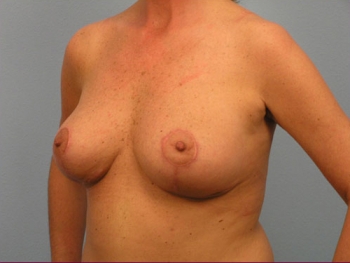 Before and After Breast Reduction