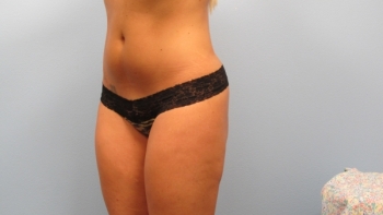 Before and After Butt Lift