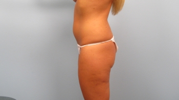 Before and After Butt Lift