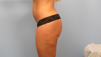 Before and After Butt Lift