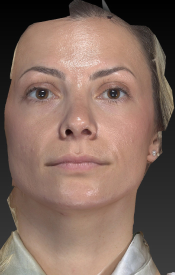 Before and After Dermal Fillers/Injectables Naples, FL