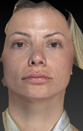 Before and After Dermal Fillers/Injectables Naples, FL