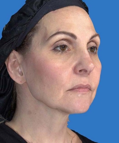 Before and After Facelift