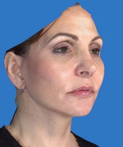 Before and After Facelift