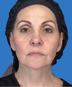 Before and After Facelift