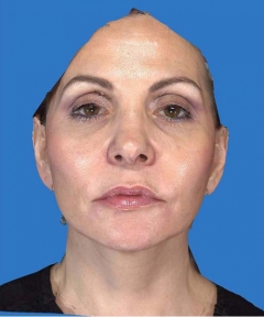 Before and After Facelift