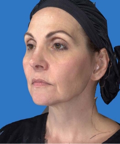 Before and After Facelift