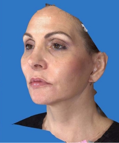 Before and After Facelift