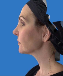 Before and After Facelift