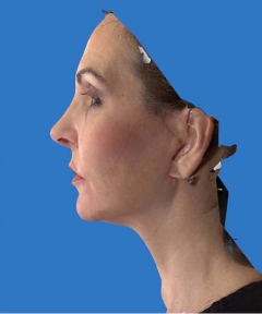 Before and After Facelift